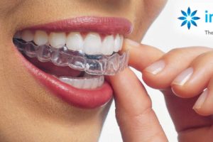 invisalign-100