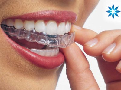 invisalign-100